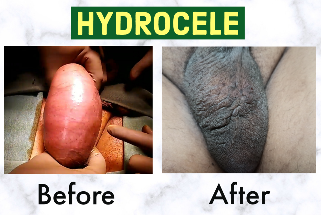 Hydrocele Surgery