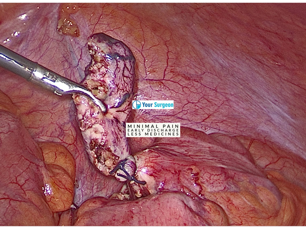 Appendicitis sorgan in body