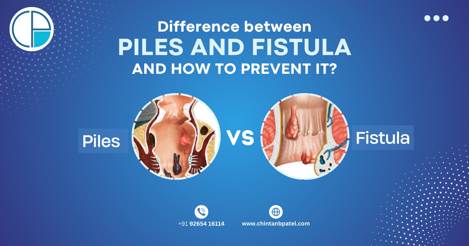 Difference between Piles and Fistula and How to Prevent it?