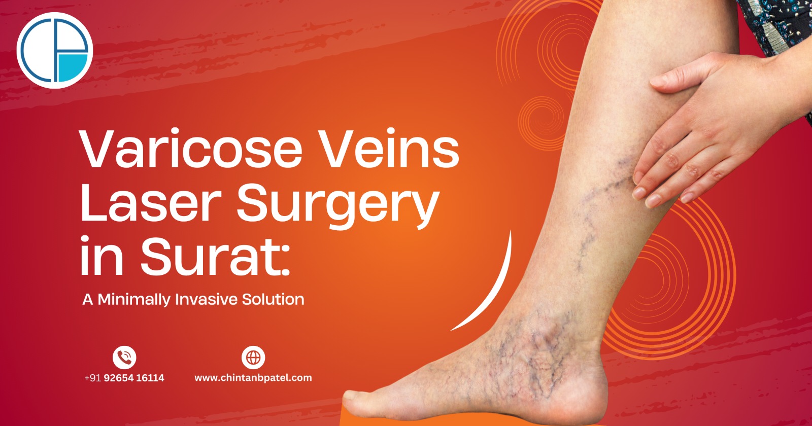 Varicose Veins Laser Surgery in Surat: A Minimally Invasive Solution