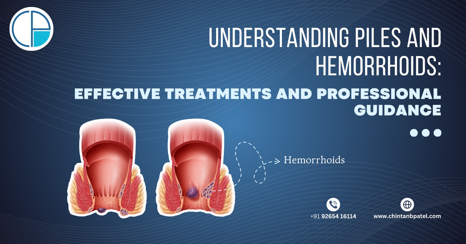 Understanding Piles and Hemorrhoids: Effective Treatments and Professional Guidance