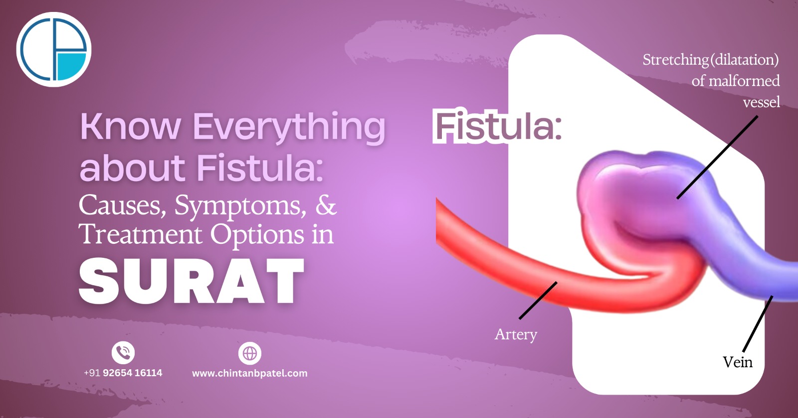 Know Everything about Fistula: Causes, Symptoms, and Treatment Options in Surat
