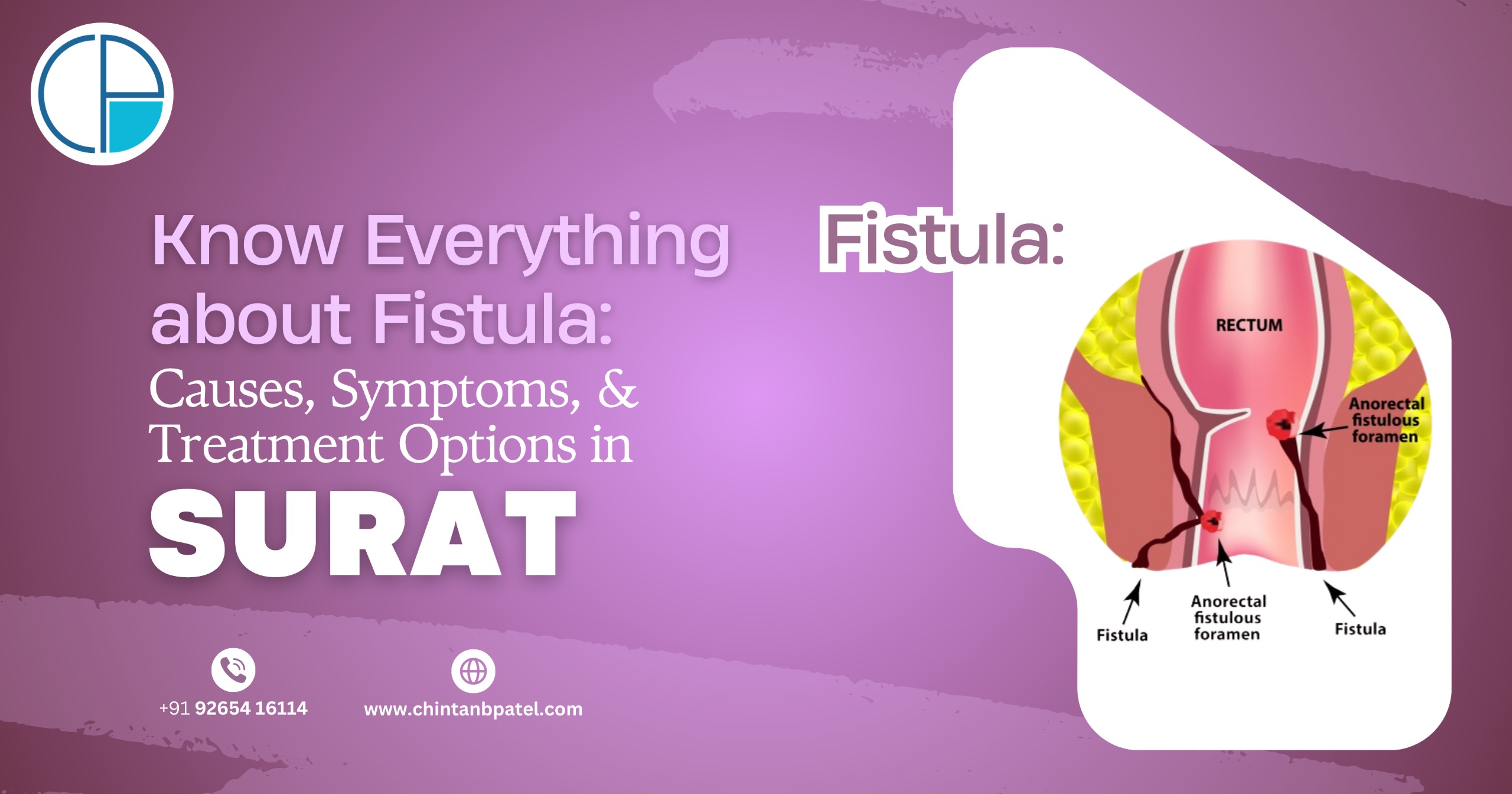 Know Everything about Fistula: Causes, Symptoms, and Treatment Options in Surat